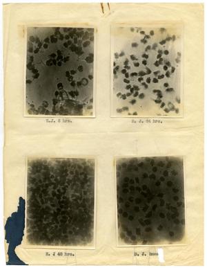Primary view of object titled '[Four Photographs of E. J.'s Sickle-Cell Anemia from Six Hours to Forty-Eight Hours]'.