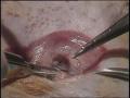 Video: [News Clip: Microsurgery]
