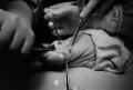 Photograph: [Operation of a bunion surgery]